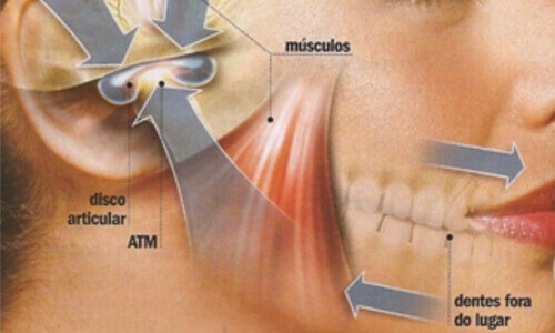 Disfunção Temperomandibular e dor facial